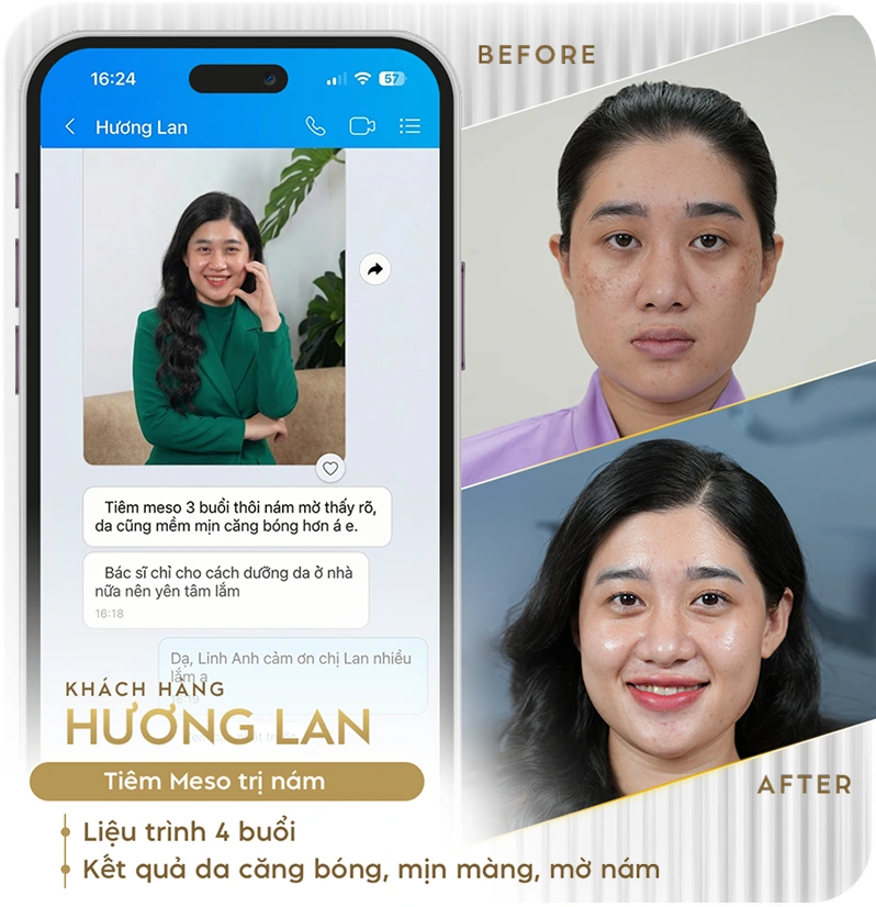 Khách hàng điều trị nám