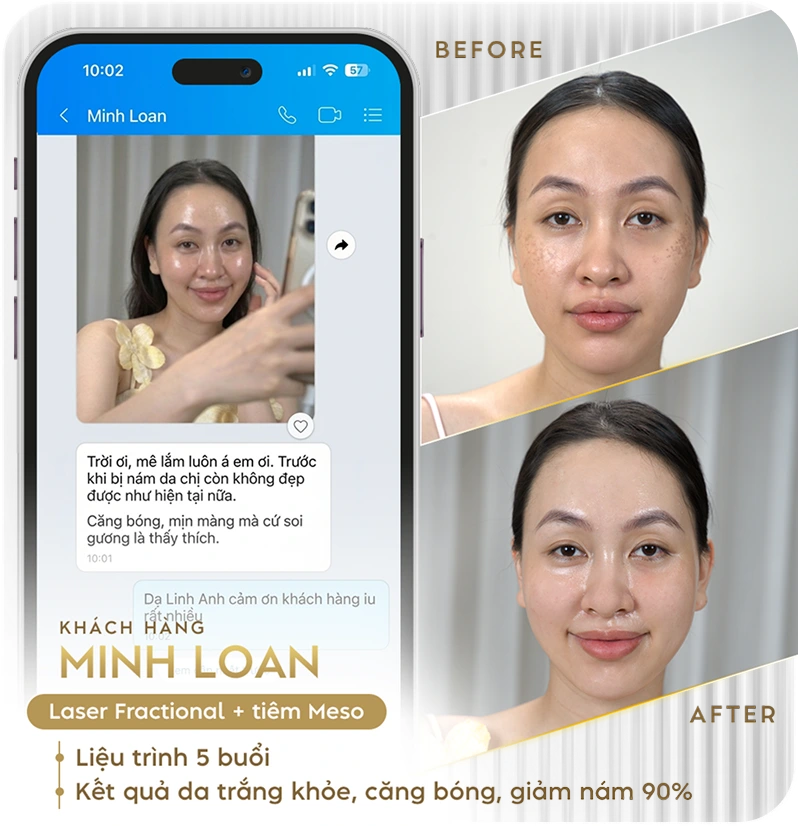 Khách hàng điều trị nám