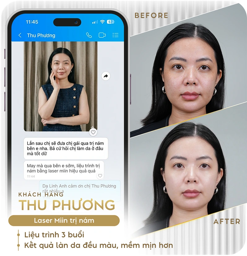 Khách hàng điều trị nám