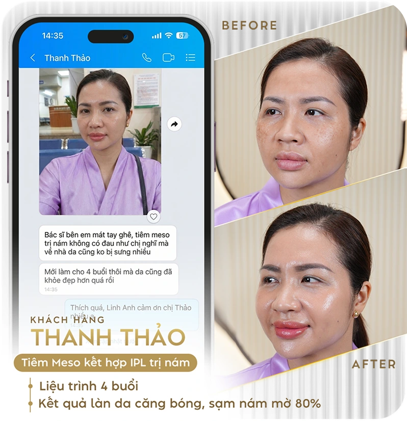 Khách hàng điều trị nám