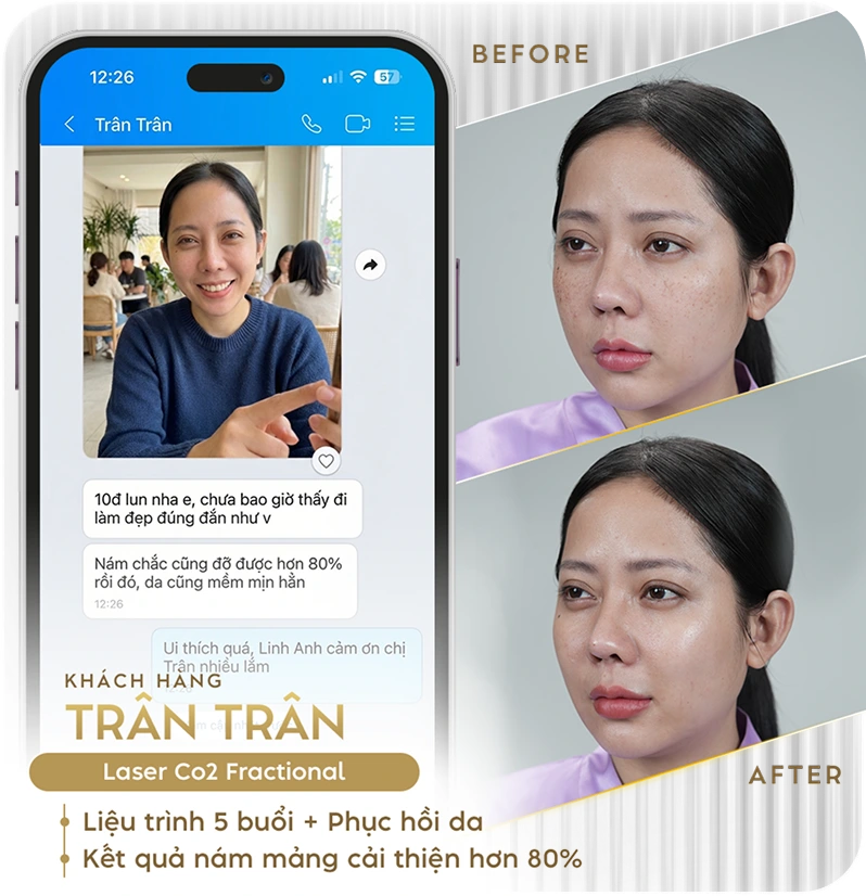 Khách hàng điều trị nám