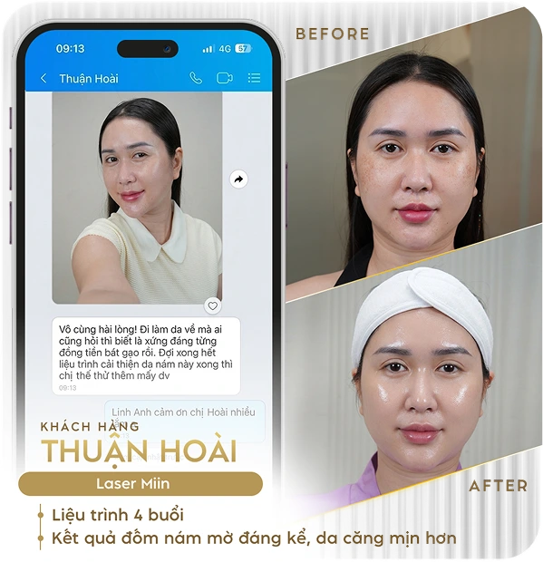 Khách hàng điều trị nám