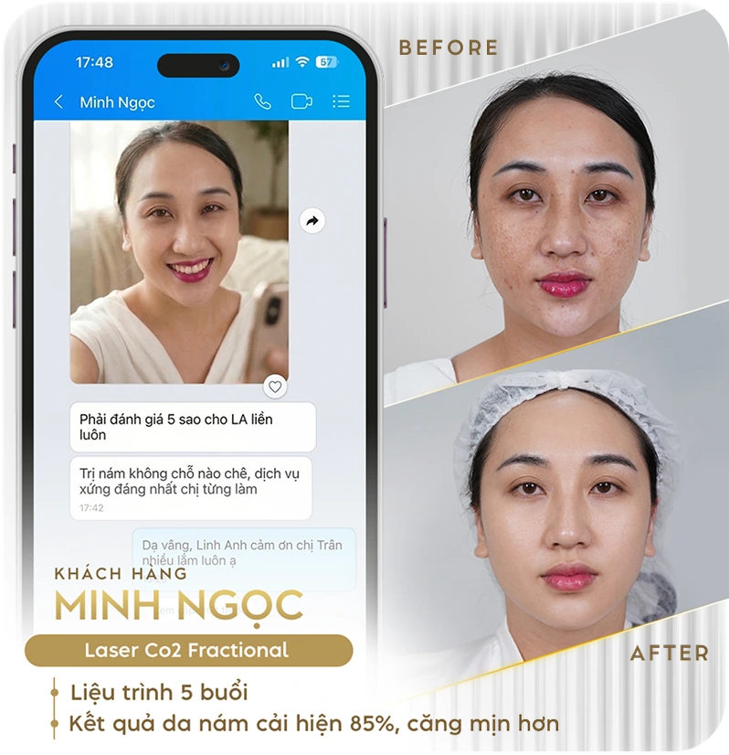 Khách hàng điều trị nám