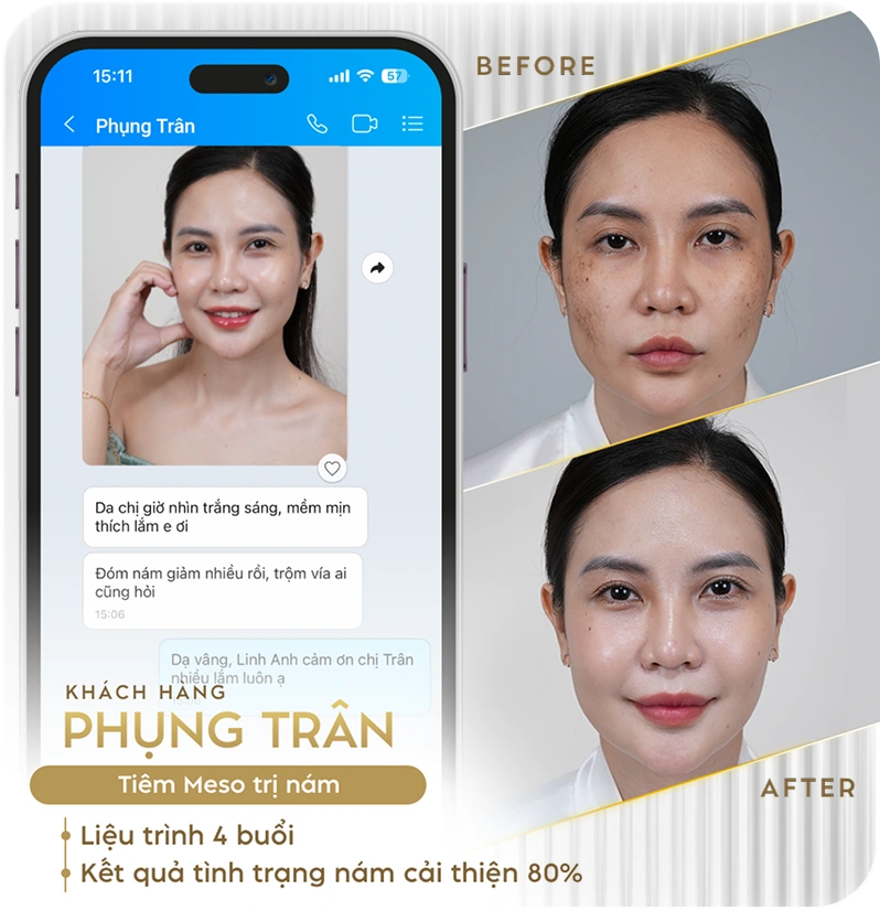 Khách hàng điều trị nám