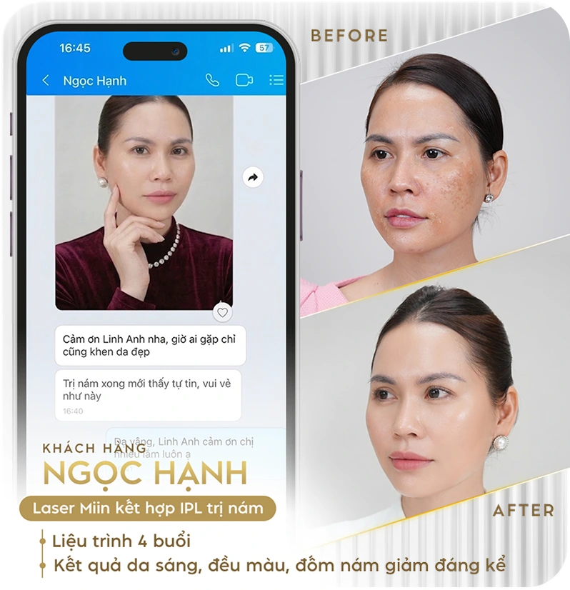 Khách hàng điều trị nám