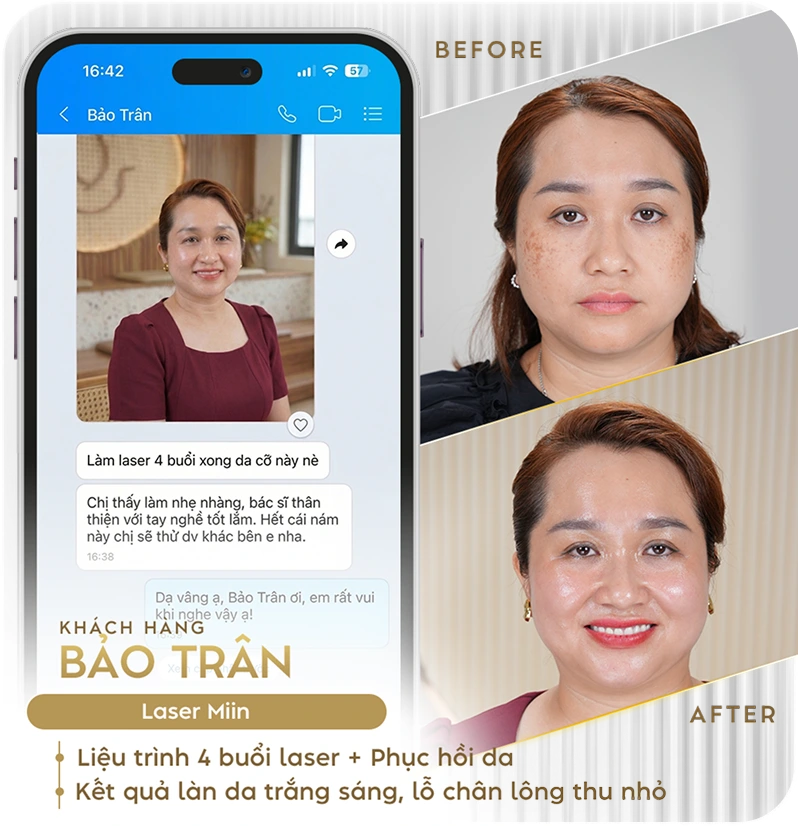 Khách hàng điều trị nám