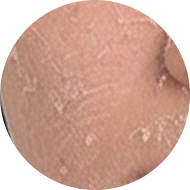 Chi tiết ĐIỀU TRỊ DÀY SỪNG DA