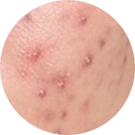 Chi tiết ĐIỀU TRỊ MỤN