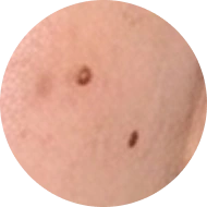 Chi tiết XÓA NỐT RUỒI