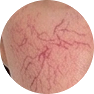 Chi tiết ĐIỀU TRỊ RẠN DA/ GIÃN MAO MẠCH