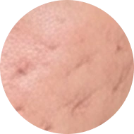 Chi tiết ĐIỀU TRỊ SẸO