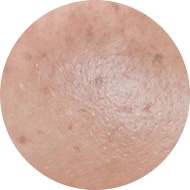 Chi tiết ĐIỀU TRỊ TÀN NHANG