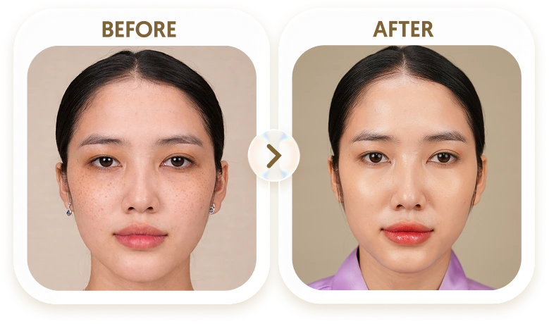 Kết quả điều trị tàn nhang của HẠNH - 31 TUỔI