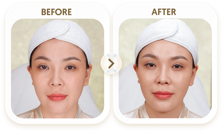 Kết quả điều trị tàn nhang của LAN - 45 TUỔI