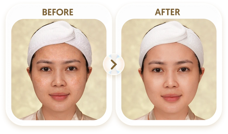 Kết quả điều trị tàn nhang của NGỌC - 36 TUỔI