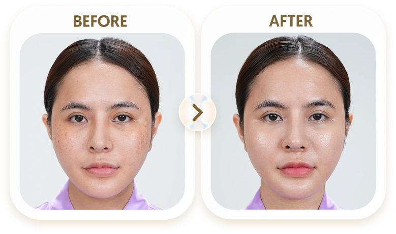 Kết quả điều trị tàn nhang của NHUNG - 29 TUỔI