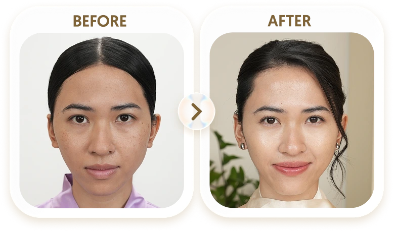 Kết quả điều trị tàn nhang của THU - 33 TUỔI