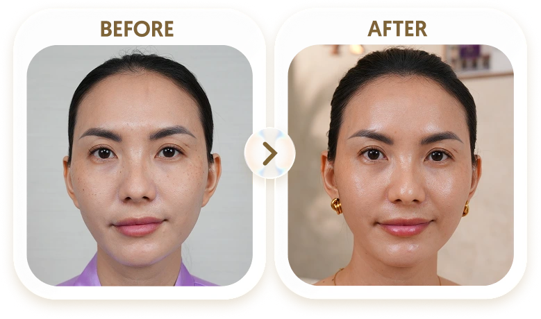 Kết quả điều trị tàn nhang của THU - 40 TUỔI