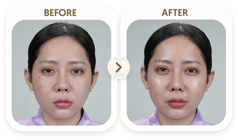 Kết quả điều trị tàn nhang của TRÂM - 34 TUỔI