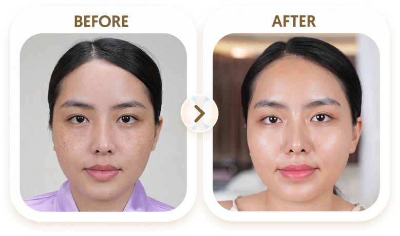 Kết quả điều trị tàn nhang của TRÂN - 30 TUỔI