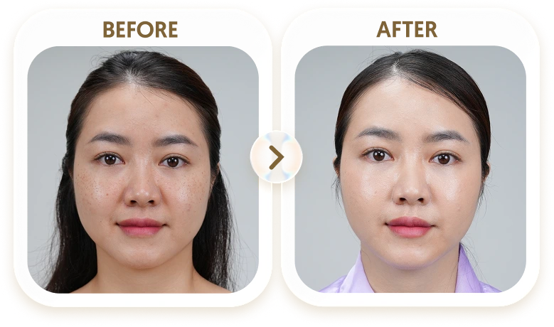 Kết quả điều trị tàn nhang của TRANG - 35 TUỔI