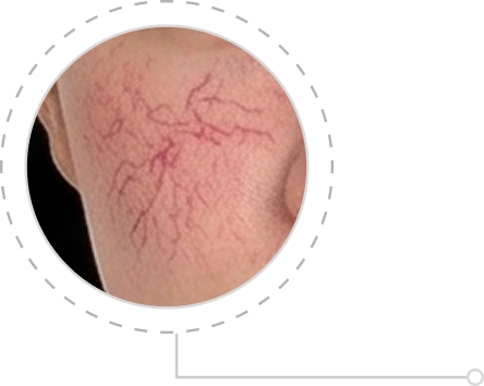 Giãn mao mạch Mobile