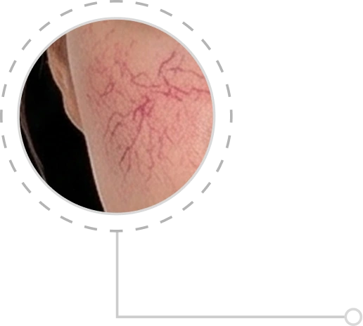 Giãn mao mạch Desktop